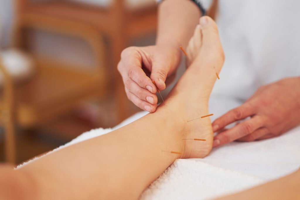 Acupuncture naturopathic medicine