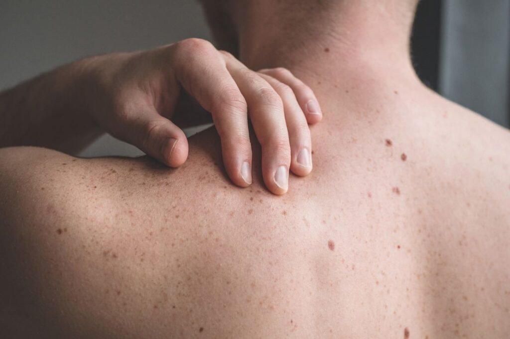 signs of skin cancer